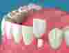 установка коронки на зуб на нижней челюсти