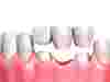 Восстановление выпавшего зуба с помощью протеза