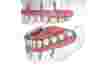3D-иллюстрация имплантационной системы «Все зубы сразу» и зубного протеза