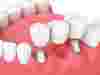 Восстановление выпавшего зуба с помощью протеза