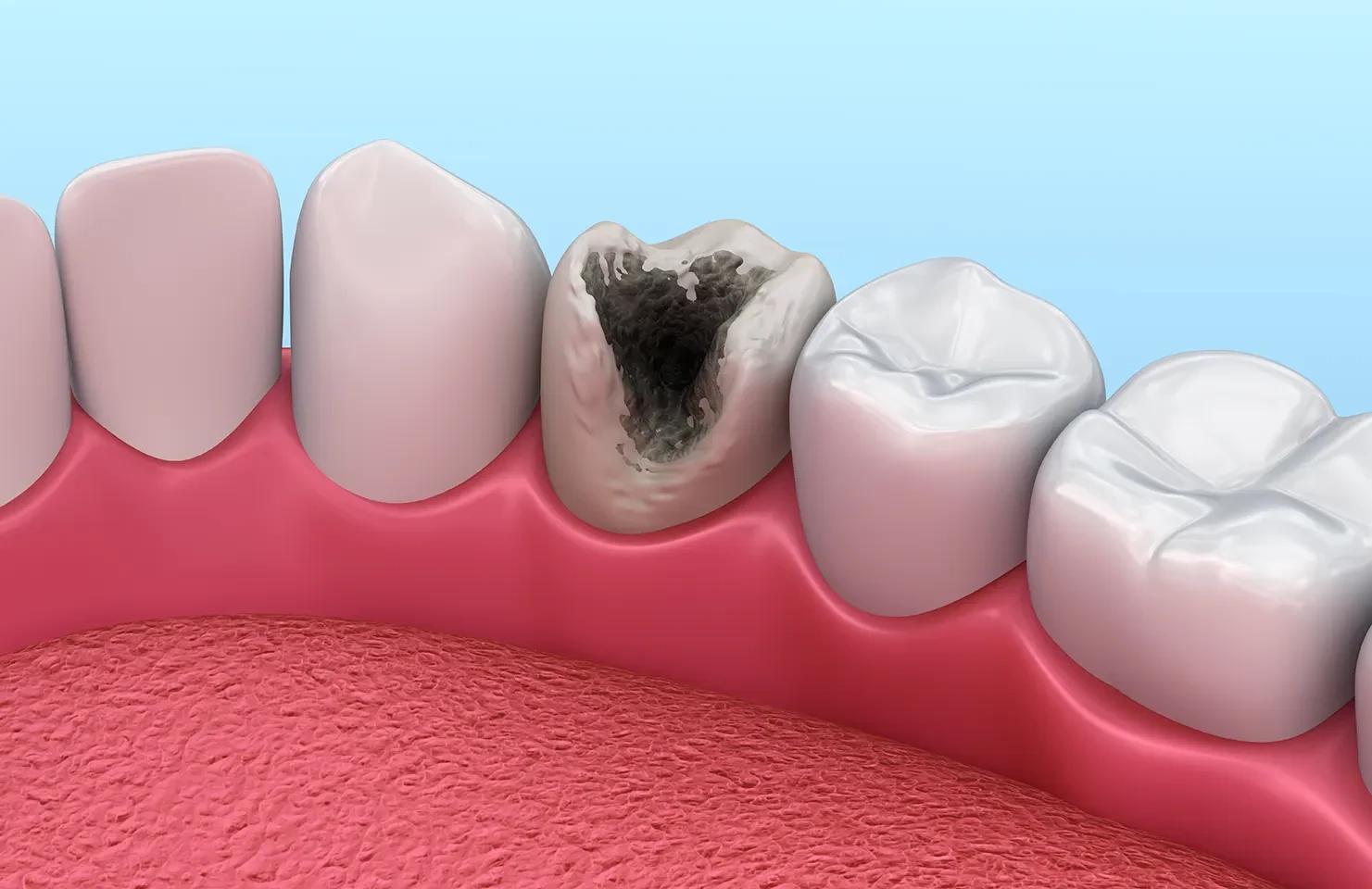 Пульпит зуба: симптомы, что делать | Профессорская стоматология